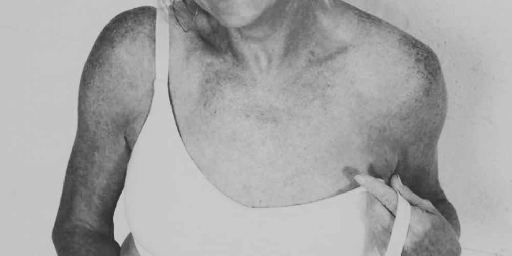 Bras For Sensitive Radiation Skin